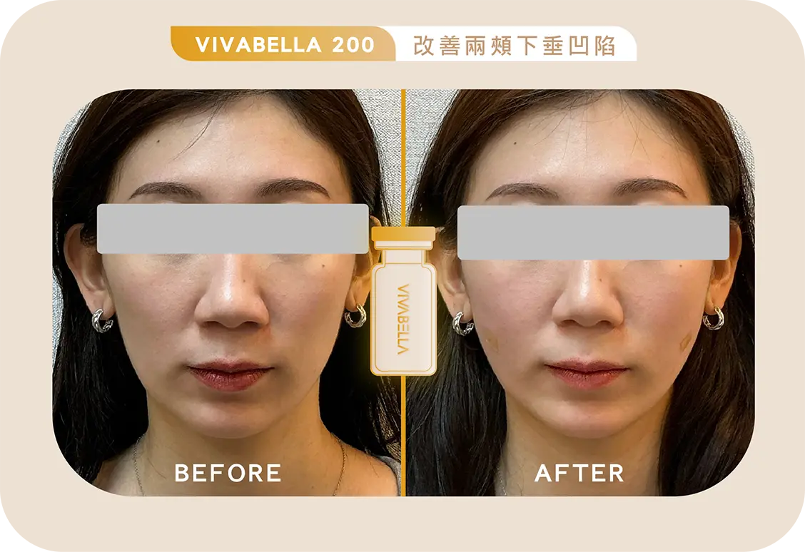 張誠醫師 頰凹下垂ab